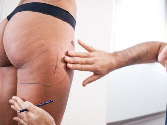 liposuzionemininv-1 liposuzionemininv 1