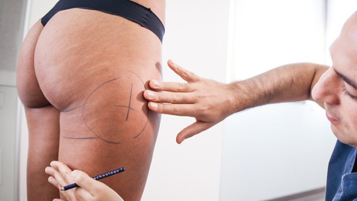 liposuzionemininv 1