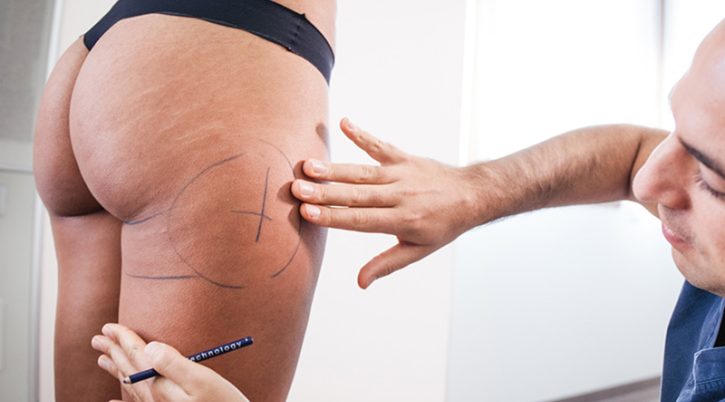 liposuzionemininv 1