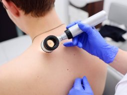 melanoma melanoma
