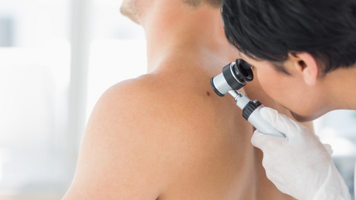 melanoma