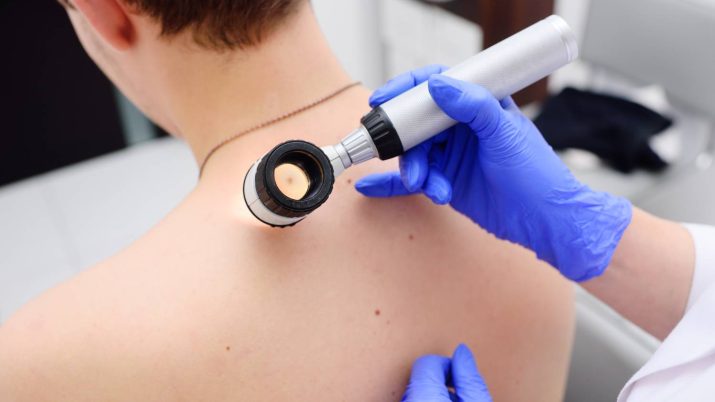 melanoma