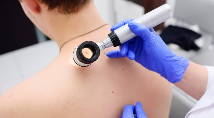 melanoma