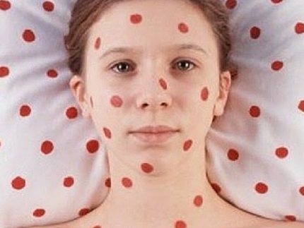 morbillo-rosolia-medium ?brizy media=35471&brizy crop=iW%3D496%26iH%3D248%26oX%3D82%26oY%3D0%26cW%3D331%26cH%3D248