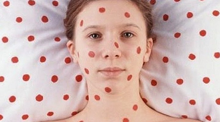 morbillo rosolia medium