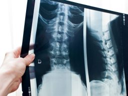 radiografia schiena