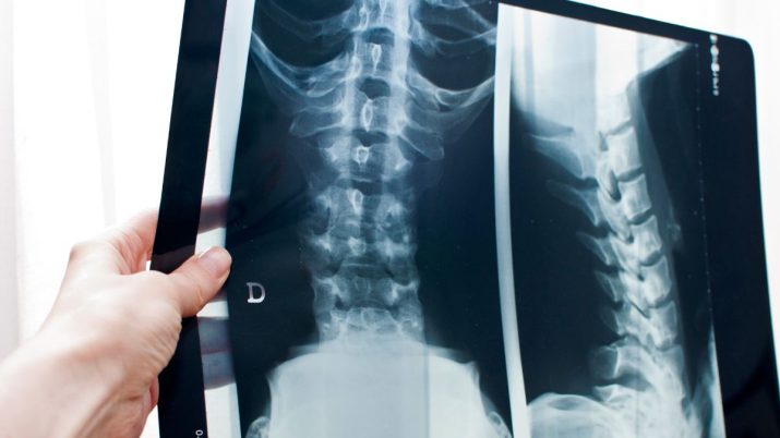radiografia schiena