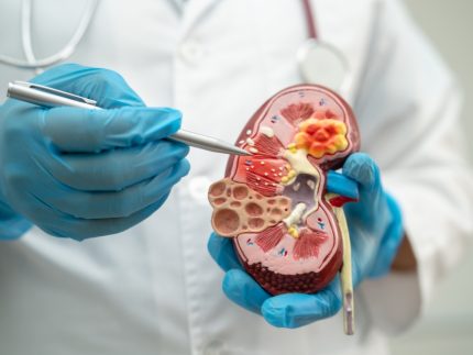 Kidney,Disease,,Chronic,Kidney,Disease,Ckd,,Doctor,Hold,Model,To ?brizy media=35482&brizy crop=iW%3D371%26iH%3D248%26oX%3D19%26oY%3D0%26cW%3D331%26cH%3D248