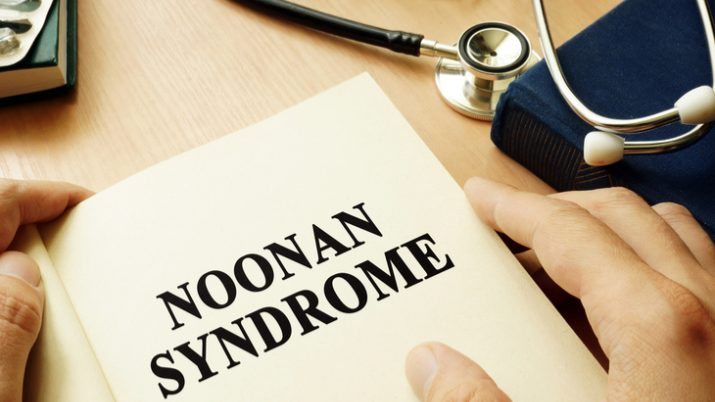 sindrome di noonan