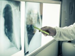 tumore ai polmoni cause diagnosi e prevenzione 1200 675