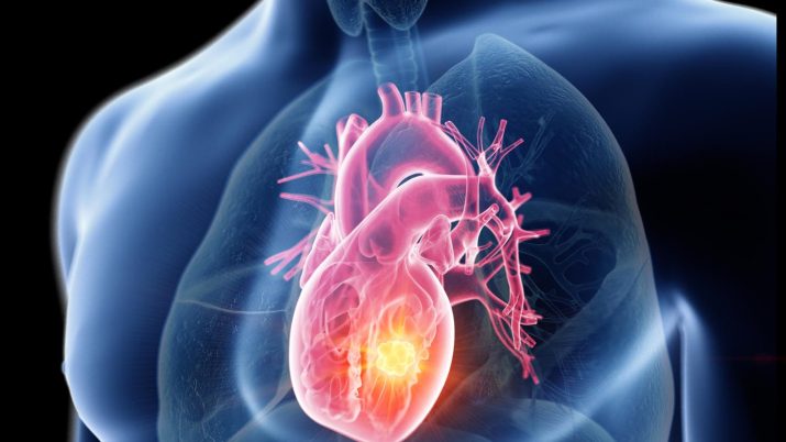 tumore cuore